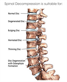 Non-surgical spinal decompression at ScolioLife Singapore