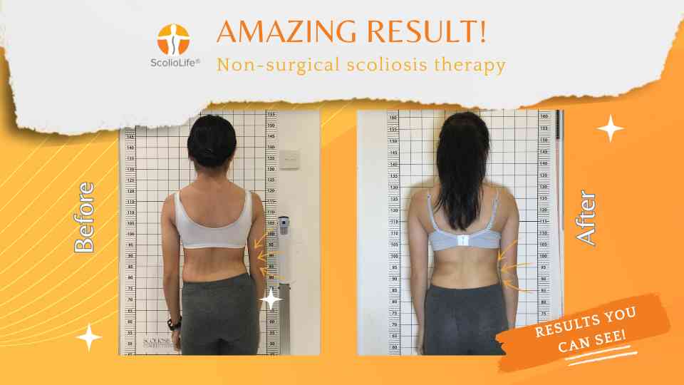 Before and after scoliosis results