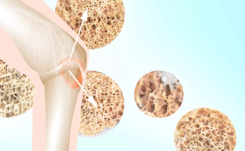 Neben Kalzium und Vitamin D-Wie man wirklich starke Knochen