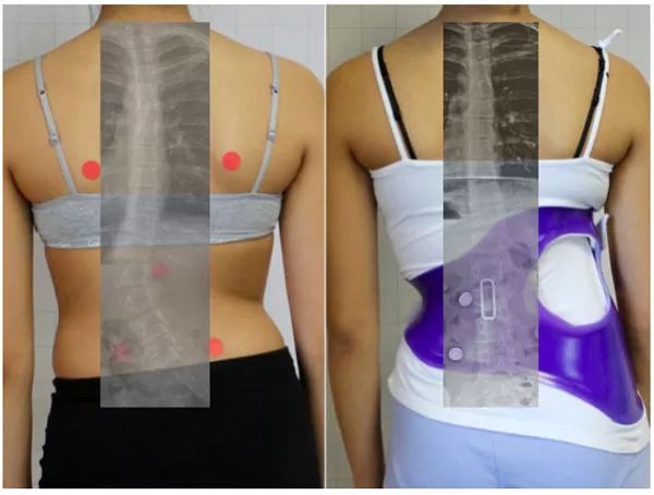 À quoi ressemble la vie avec un corset de scoliose