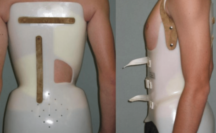 What Life is Like Wearing a Scoliosis Brace