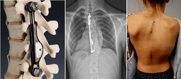 Demonstration of Apifix placed in the spine and the surgical wound