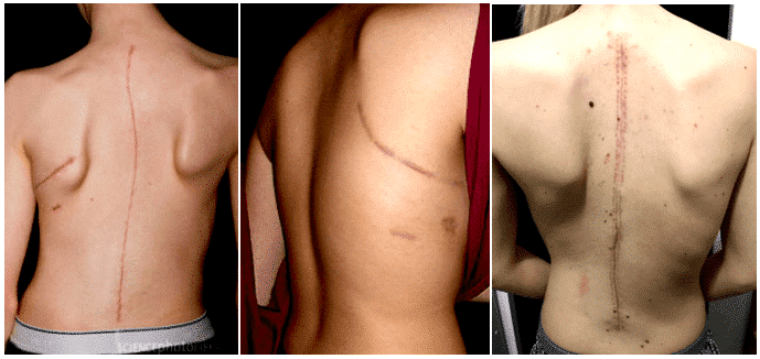 Scars formed from different spine surgeries