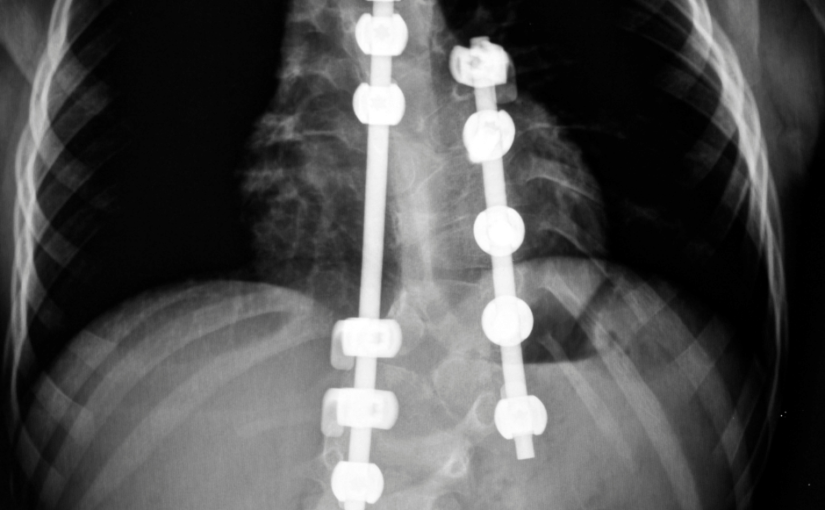 Últimos Avances en Cirugía de Escoliosis