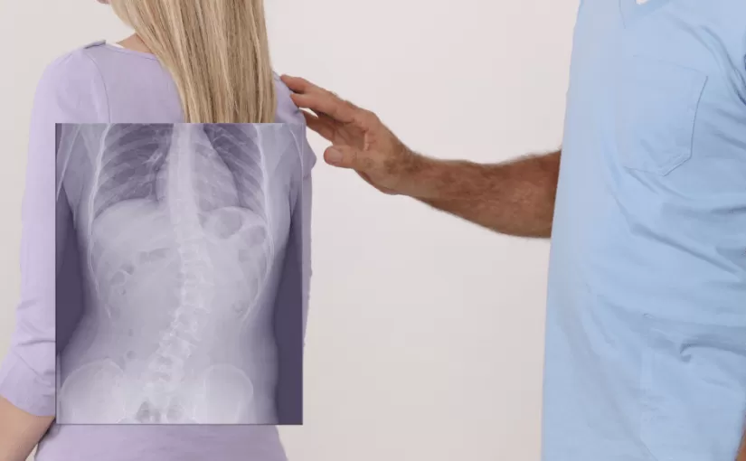 Informazioni sul metodo di trattamento della scoliosi ScolioLife