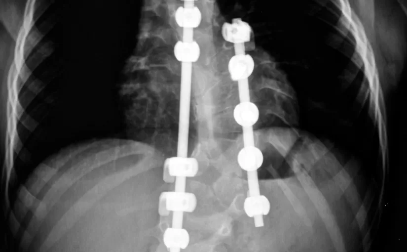 在脊柱侧凸治疗方法中支柱和脊柱外科手术最没效果；真正的希望在别处。