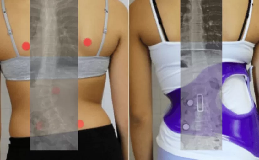 ¿Cuán efectivo es el soporte ortopédico para la escoliosis?