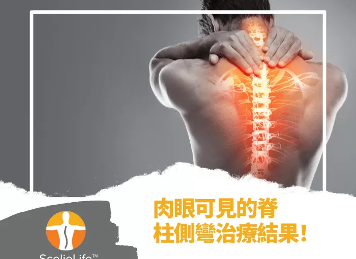 管理脊柱健康的脊柱側彎專家劉子傑醫生