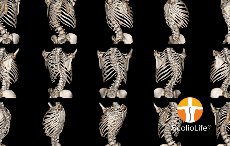 Understanding the Cause of Scoliosis: The Hueter-Volkmann Law