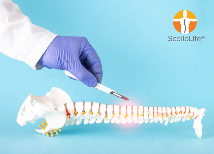 Vertebral Body Tethering Mungkin Tidak Memperbaiki Sudut Cobb