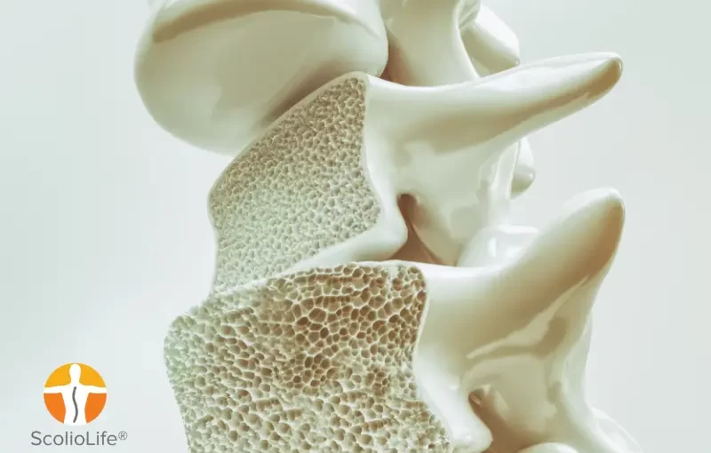 Scoliosis & Osteoporosis: The Top Tactics to Prevent Low Bone Mass & Osteoporosis in 2023