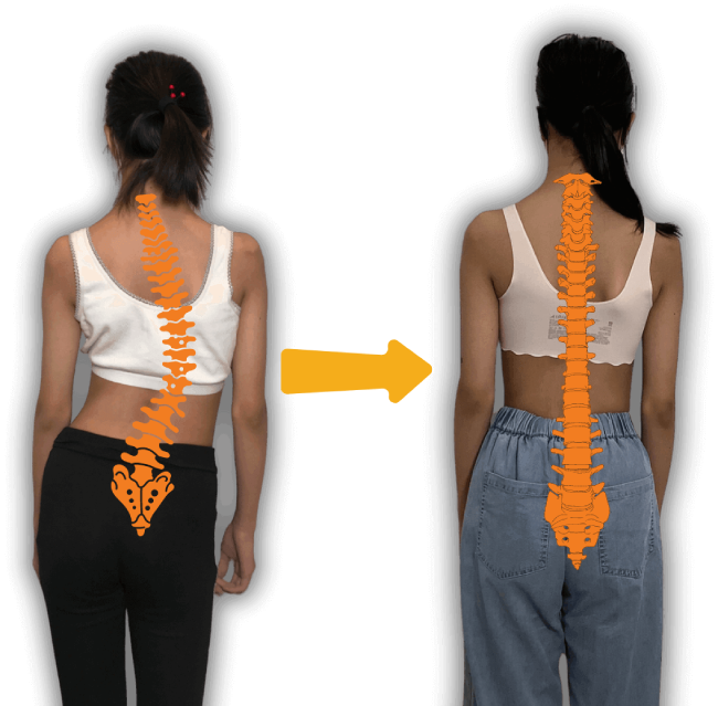 ScolioLife™ Scoliosis Specialist Surgery Clinic and Doctor in USA