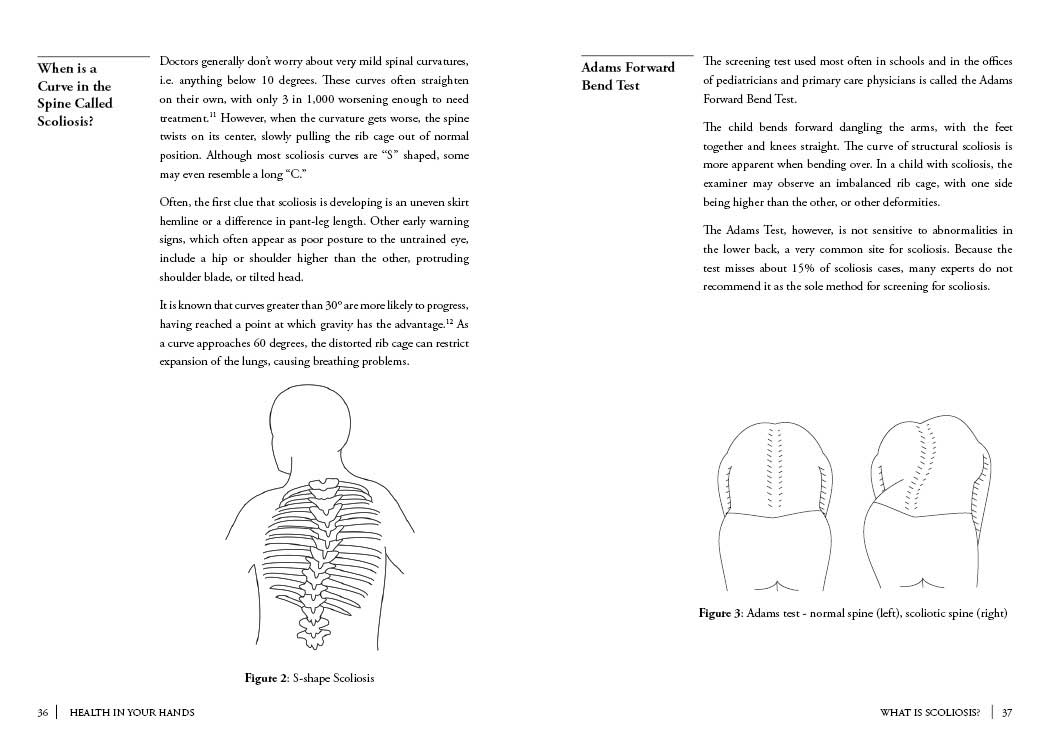 Scoliosis-Natural-Treatment