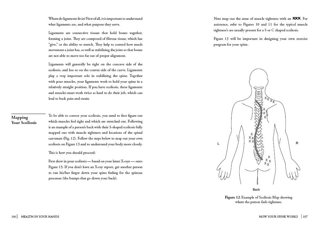Scoliosis-Natural-Treatment
