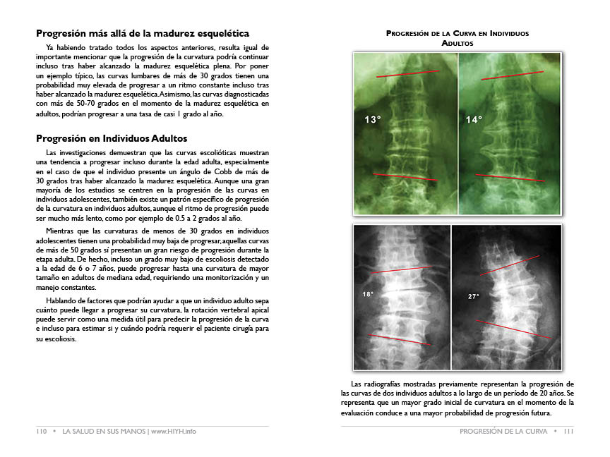 Scoliosis-Surgery
