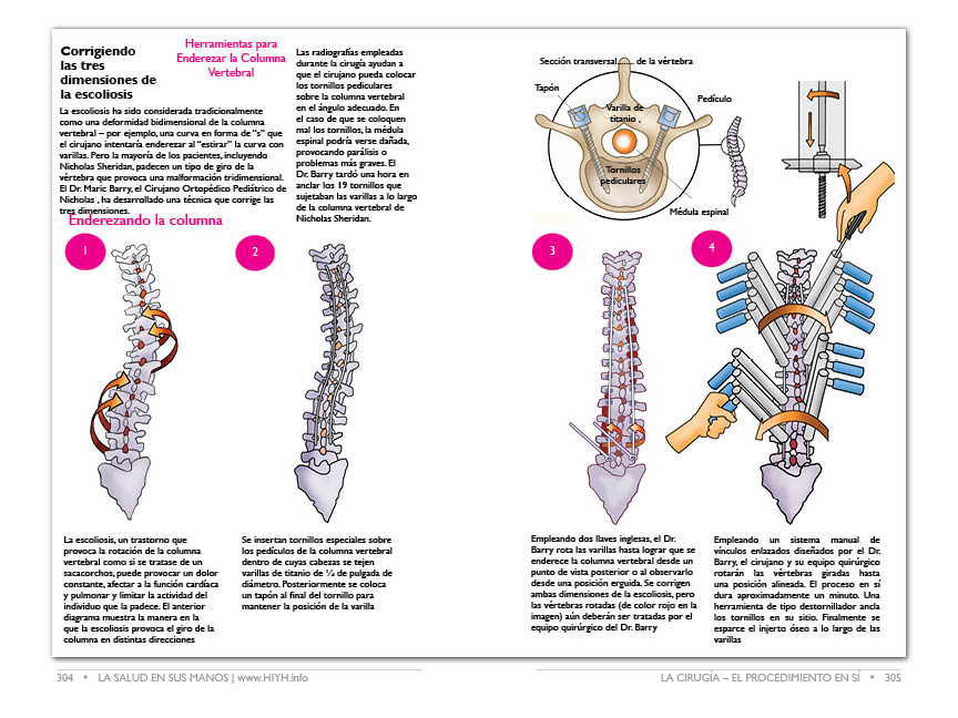 Scoliosis-Surgery