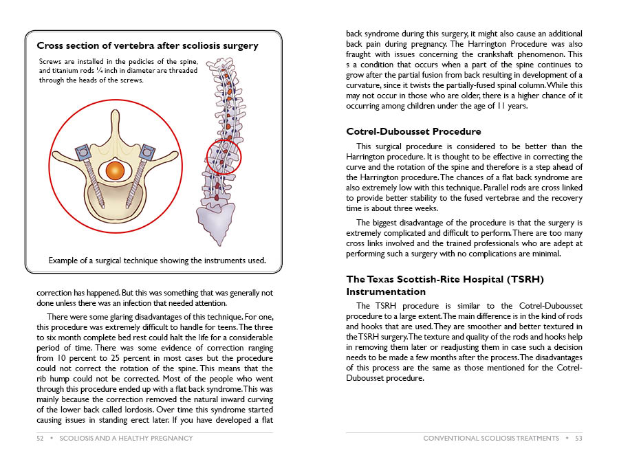Pregnancy And Scoliosis Book