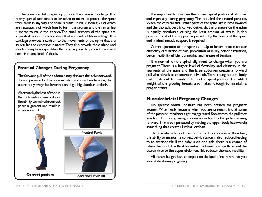 Pregnancy And Scoliosis Book