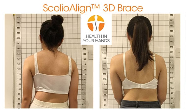 ScolioAlign 3D brace fitting front