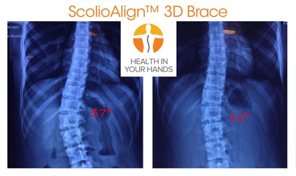 ScolioAlign 3D brace fitting side