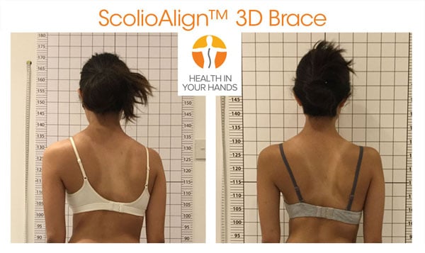 ScolioAlign 3D brace fitting back