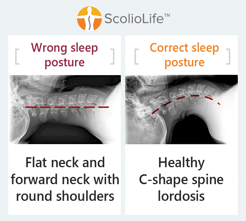 Neutral spinal alignment on ScolioPillow