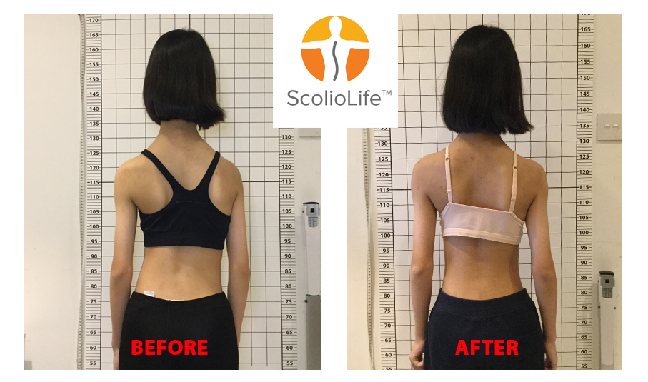 ScolioAlign 3D brace custom CAD CAM fit