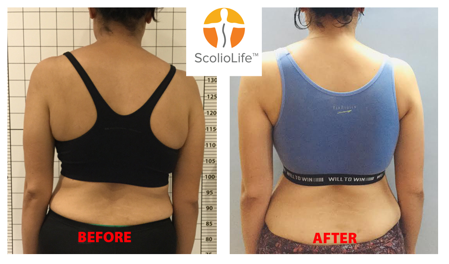 ScolioAlign 3D printed over-corrective scoliosis brace front view