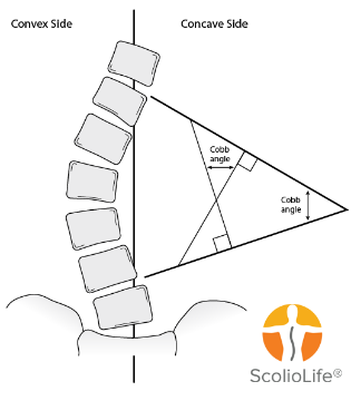 thumb_PED-Cobb-angle
