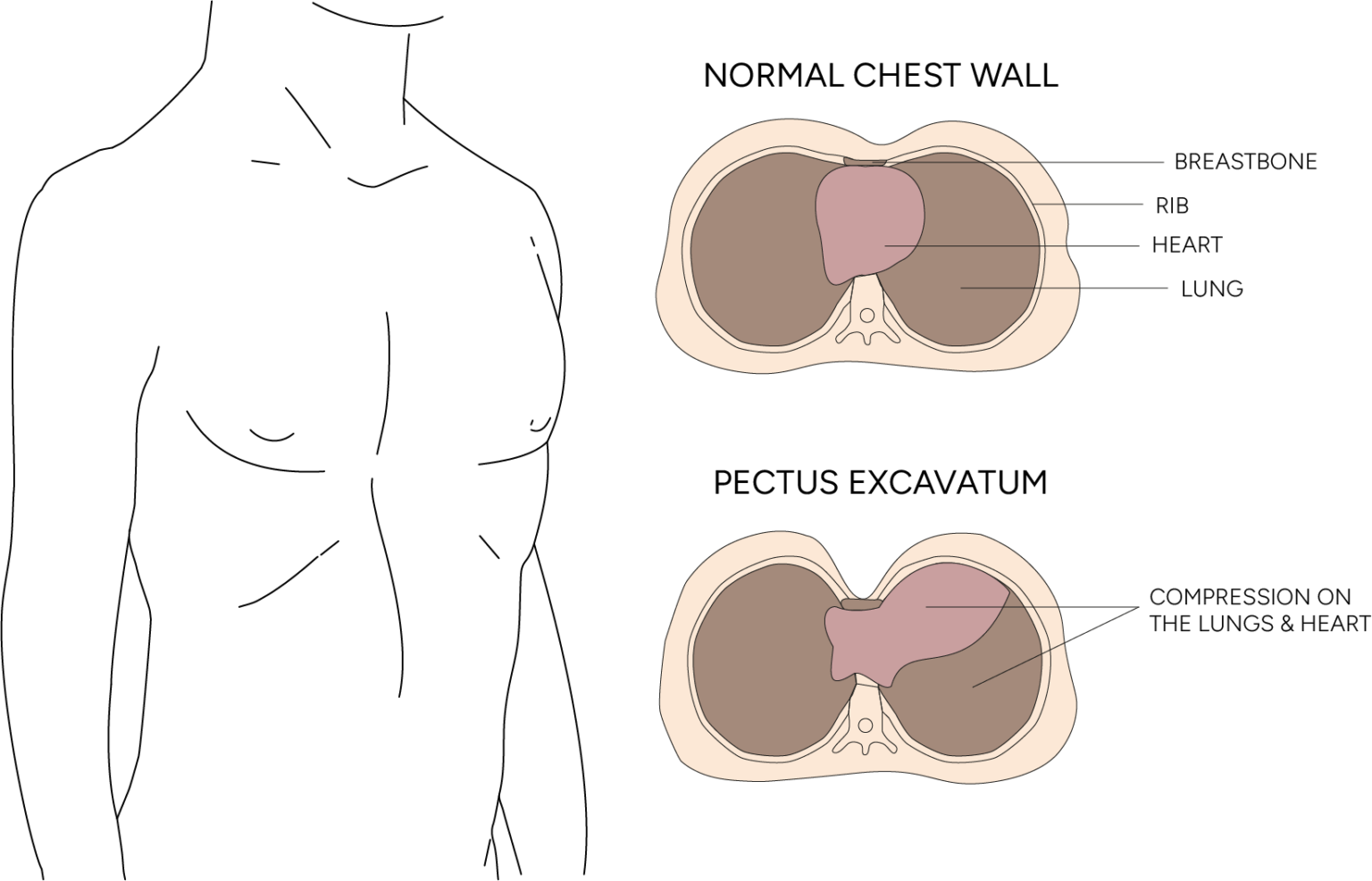 HHCCTEO Campana per Vuoto per Pectus excavatum, tutore per ortesi per Pectus excavatum, tutore per Pectus excavatum Correzione Fisica del Pectus excavatum con manometro(L