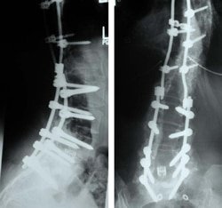 spinal12