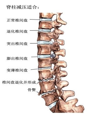 spinal-decompression