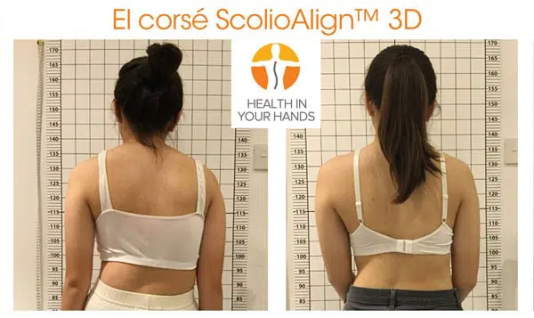 Corsé ScolioAlign™ 3D