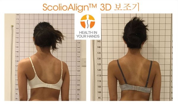 ScolioAlign™ 3D 보조기