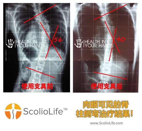 Xrays-before-and-after-01-CN