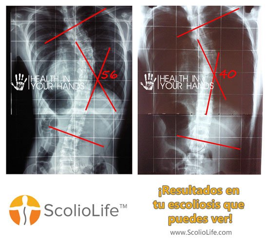Xrays-before-and-after-01-ES