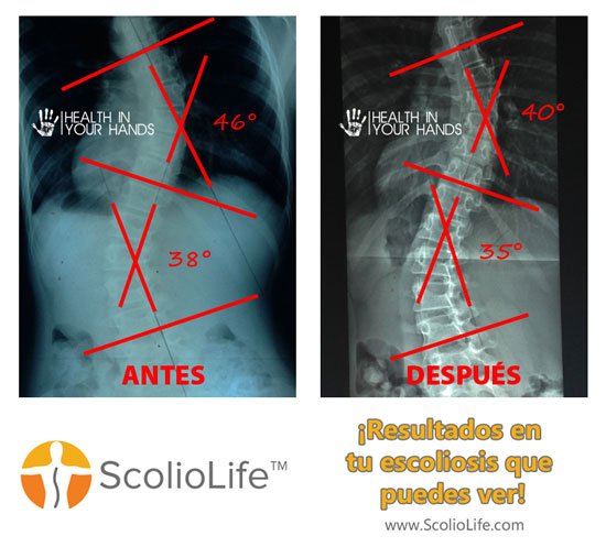 Xrays-before-and-after-03-ES