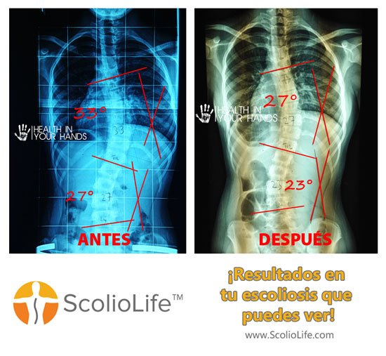 Xrays-before-and-after-04-ES