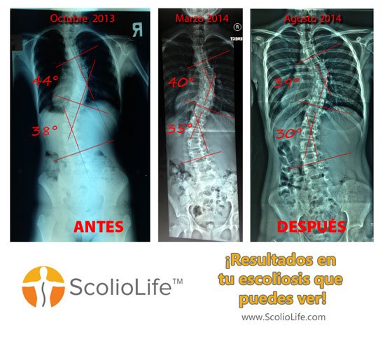 Xrays-before-and-after-05-ES