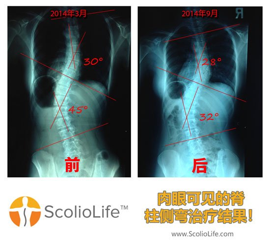 Xrays-before-and-after-06-CN