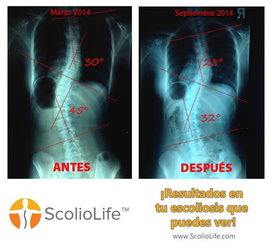 Xrays-before-and-after-06-ES