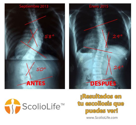 Xrays-before-and-after-07-ES