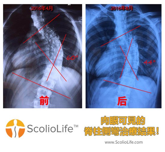 Xrays-before-and-after-08-CN