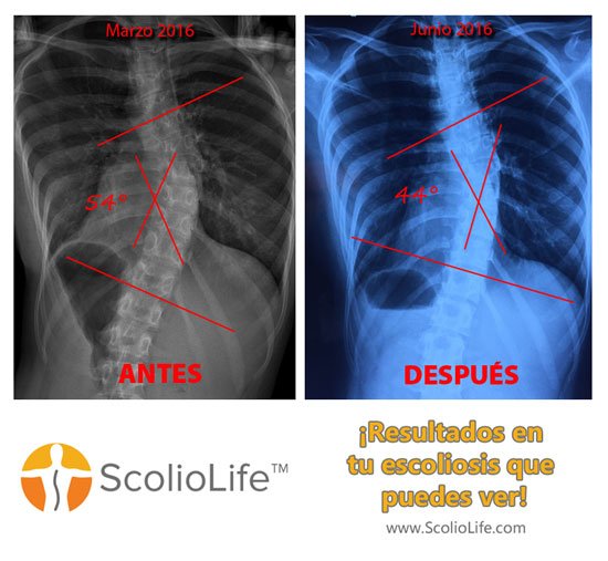 Xrays-before-and-after-09-ES