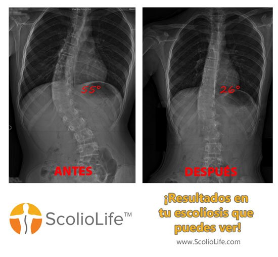 Xrays-before-and-after-10-ES