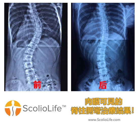 Xrays-before-and-after-11-CN