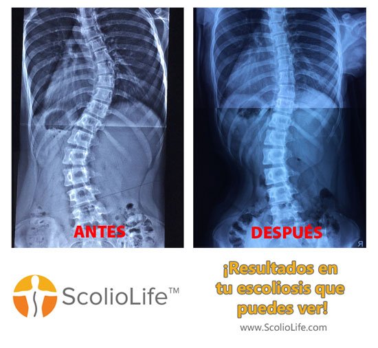 Xrays-before-and-after-11-ES