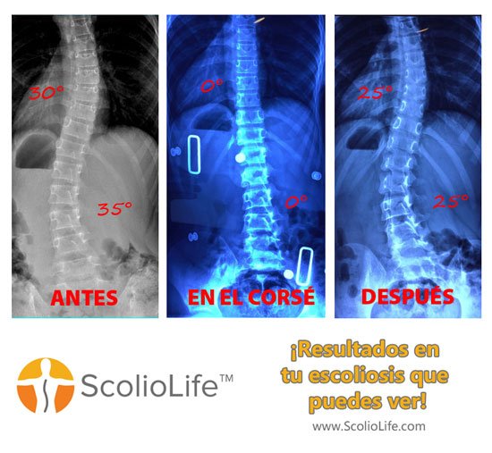 Xrays-before-and-after-14-ES