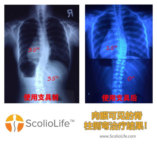 Xrays-before-and-after-15-CN