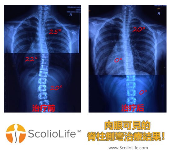 Xrays-before-and-after-17-CN